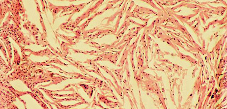 Cholesterinkristalle  