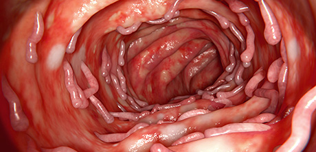 Colitis ulcerosa