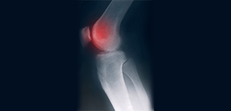 Psoriatische Arthritis