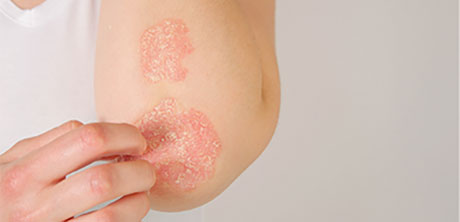 Plaque Psoriasis