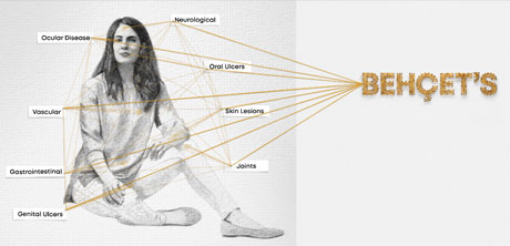 Behçet-Krankheit